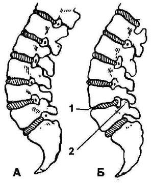 А - позвоночник здорового человека; Б - позвоночник больного человека: 1 - межпозвоночный хрящевой диск; 2 - ущемление корешков спинномозговых нервов